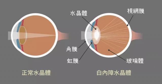 白內障患者必看!上海眼科院長教你如何選出適合自己的人工晶體 白內障患者必看!上海眼科院長教你如何選出適合自己的人工晶體