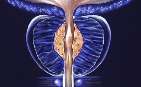 細菌性前列腺炎是怎么回事?細菌性前列腺炎的癥狀