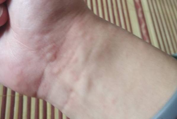 芒果過(guò)敏會(huì)死人嗎 芒果輕度過(guò)敏的癥狀 芒果過(guò)敏會(huì)死人嗎 芒果輕度過(guò)敏的癥狀