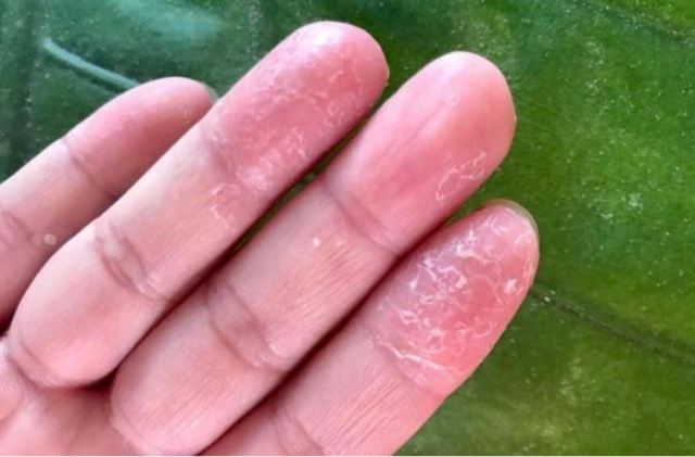 治療手癬用什么藥膏 手癬有哪些類型 治療手癬用什么藥膏 手癬有哪些類型
