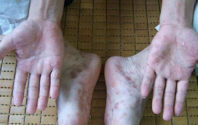 手足癬表現有什么 用醋加鹽泡腳的好處有什么呢 手足癬表現有什么 用醋加鹽泡腳的好處有什么呢