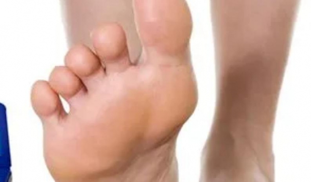 手足癬表現(xiàn)有什么癥狀 手足癬有哪些病癥 手足癬表現(xiàn)有什么癥狀 手足癬有哪些病癥