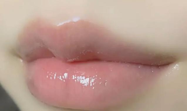 嘴唇周圍發(fā)黑怎么回事 唇周黑色素怎么去除 嘴唇周圍發(fā)黑怎么回事 唇周黑色素怎么去除