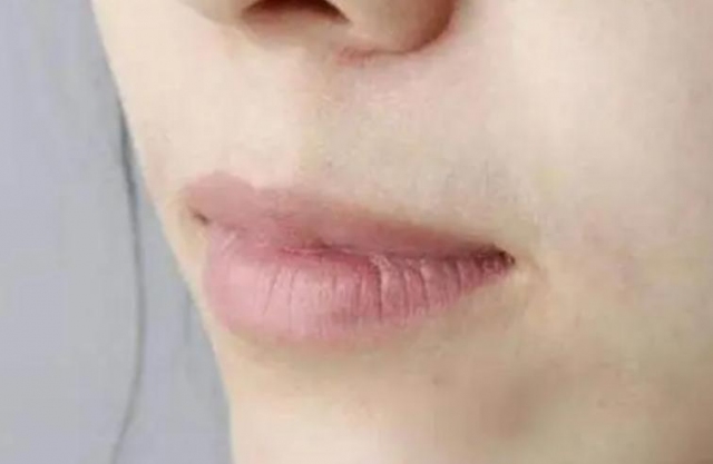 嘴唇發(fā)黃是什么病 唇周長痘是什么原因引起的 嘴唇發(fā)黃是什么病 唇周長痘是什么原因引起的