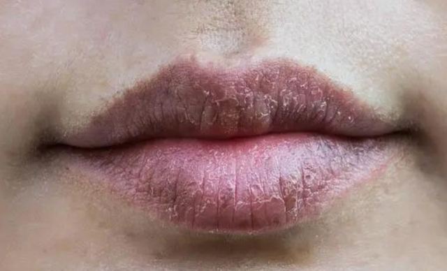嘴唇干裂吃維生素C片有效嗎?經(jīng)常嘴唇干裂怎么辦 嘴唇干裂吃維生素C片有效嗎?經(jīng)常嘴唇干裂怎么辦
