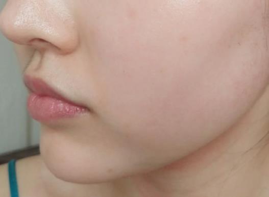 為何很多醫(yī)生不給開異維A酸?吃異維a酸能治好痤瘡嗎 為何很多醫(yī)生不給開異維A酸?吃異維a酸能治好痤瘡嗎