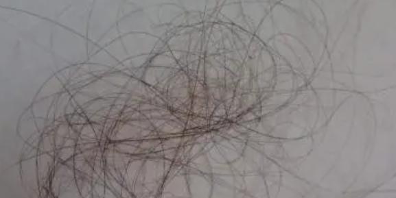 掉頭發(fā)嚴重補充什么維生素 掉頭發(fā)嚴重是遺傳問題嗎 掉頭發(fā)嚴重補充什么維生素 掉頭發(fā)嚴重是遺傳問題嗎