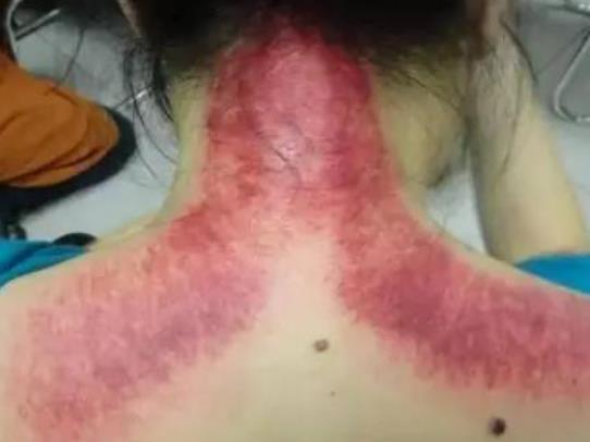 面部怎么進(jìn)行刮痧?眼部刮痧后為什么眼袋會加重 面部怎么進(jìn)行刮痧?眼部刮痧后為什么眼袋會加重