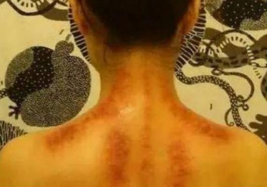 類風濕可以刮痧嗎?刮痧可以治療失眠嗎 類風濕可以刮痧嗎?刮痧可以治療失眠嗎