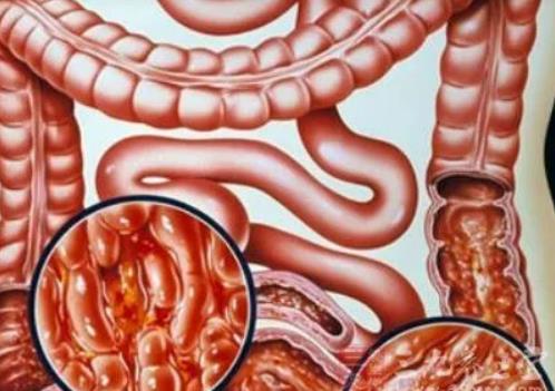 治結腸炎用哪些中藥?結腸炎如何檢查 治結腸炎用哪些中藥?結腸炎如何檢查